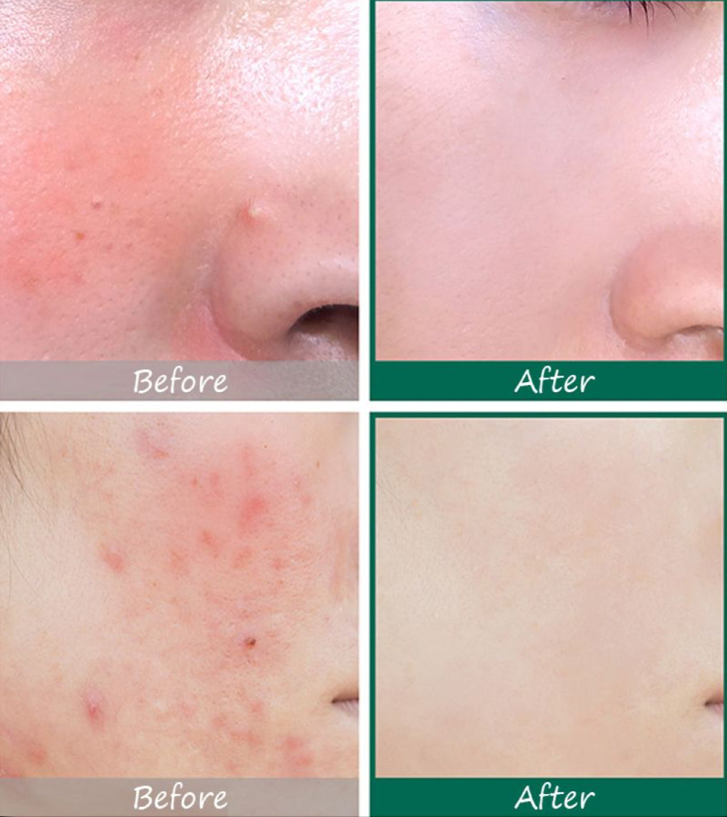 Aziderm Cream
AZELAIC ACID 20% | Dreamscape