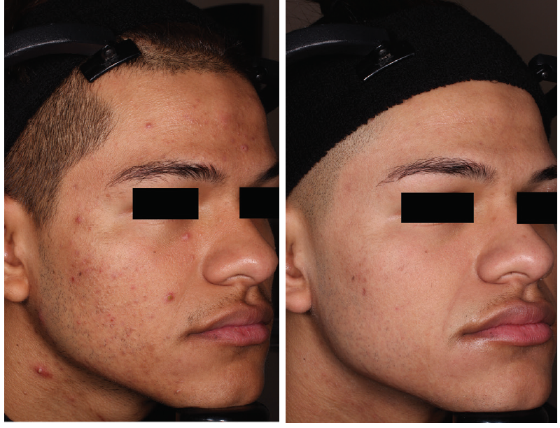 TAZAROTENE CREAM 0.1% Powerful medical grade age reversal cream  and anti acne cream | Dreamscape