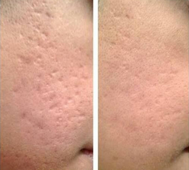 TAZAROTENE CREAM 0.1% Powerful medical grade age reversal cream  and anti acne cream | Dreamscape